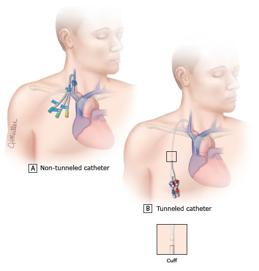 중심정맥관을 이용한 혈액투석(Dual lumen cath vs Perm cath)-대체 이 둘 차이가 뭐야? : 네이버 블로그