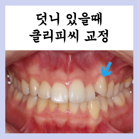  클리피씨 비발치 송곳니 덧니 교정 후기