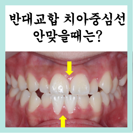  반대교합과 치아중심선이 안맞는경우 교정 후기
