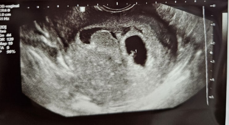 임신 극초기증상 | 4주3일 아기집 확인 | 초기 피고임 증상 기록