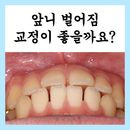  앞니 벌어짐 교정과 임플란트 사진정리 및 후기
