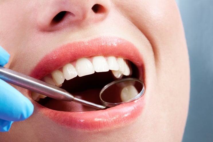 양치 안하면 치매 잘걸린다? 치매 예방을 위해서는 치아 잇몸 관리, 잇몸병 치주질환 치료(치주염), 치과 진료가 필수.
