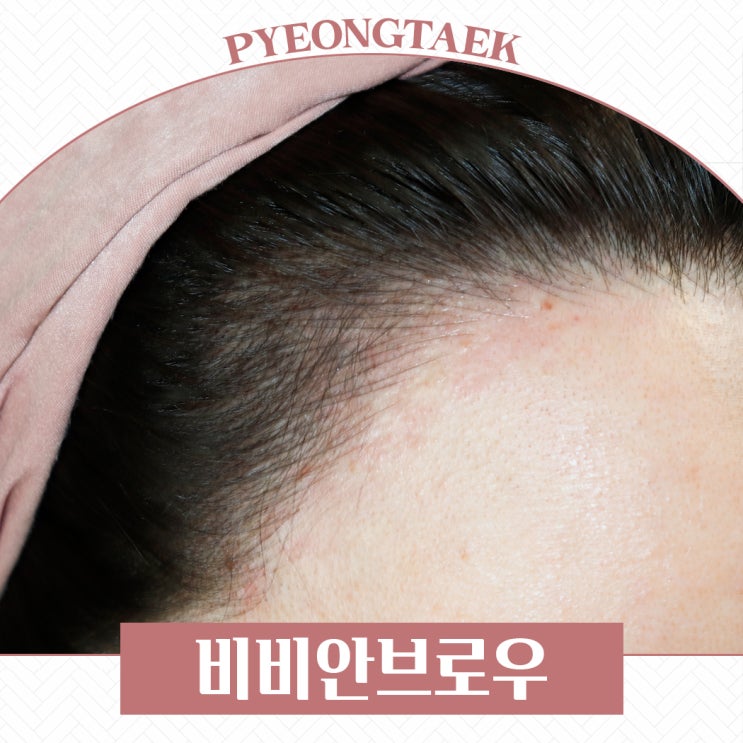  평택 헤어라인하고 네모빔 탈출했어요