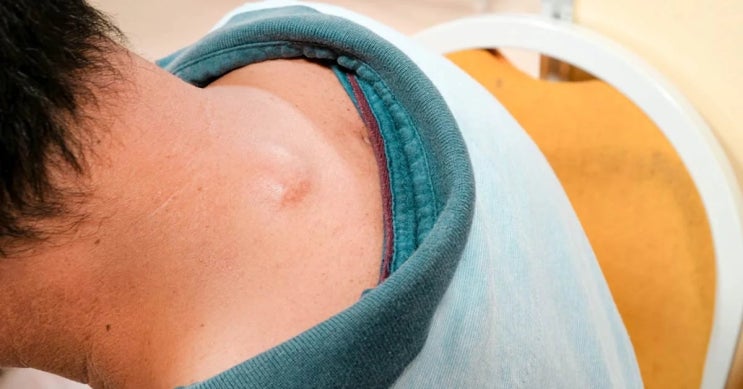  모발 주변 피부에 잘 생기는 양성 피부질환 1편 - 표피낭종과 피지낭종