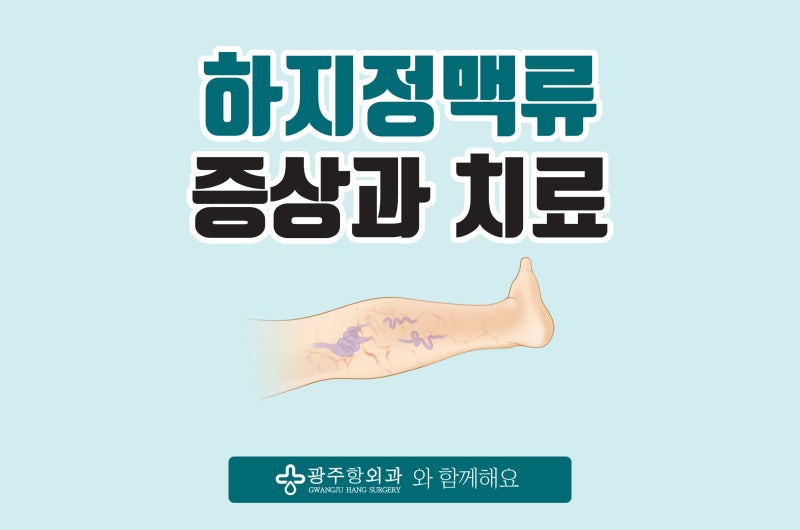 경기광주하지정맥류 증상과 치료 방법은?