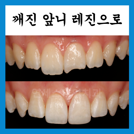  앞니 깨짐 레진으로 때운 후기와 앞니성형 (노원치과)