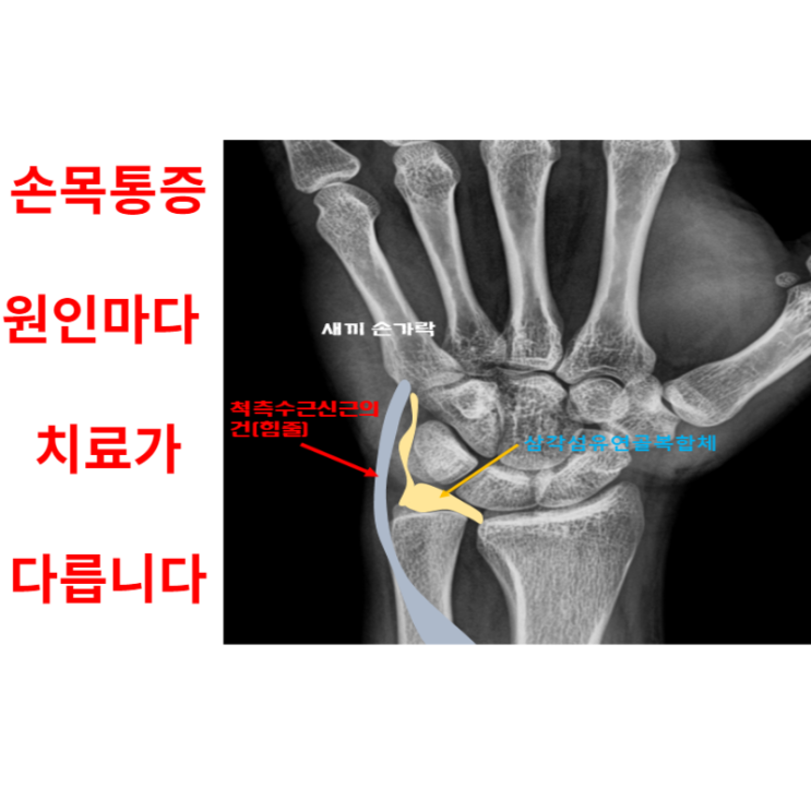  척측수근신근 손목건초염, 통증의 원인을 아셔야만 합니다