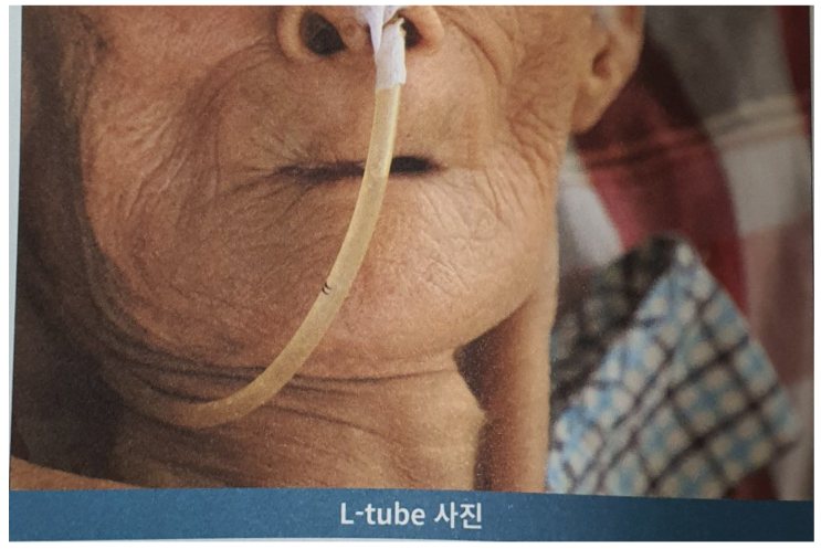  위암 증상-소화불량, 오심, 구토