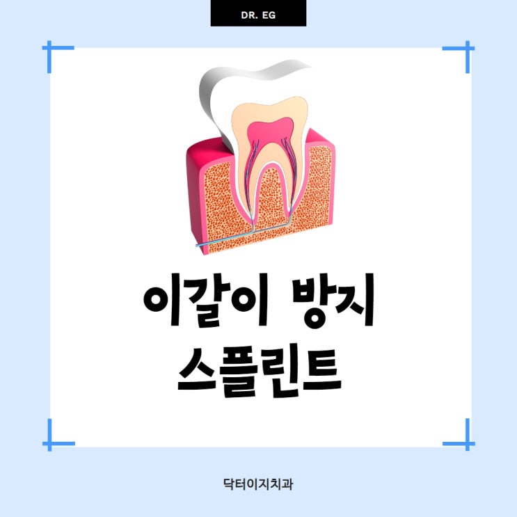  심한 이갈이로 두통과 수면장애를 겪고 있다면 스플린트를 통해 해결하세요.