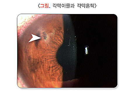 각막혼탁과 반흔, 원인, 증상, 치료법 정리 : 네이버 블로그