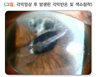 각막혼탁과 반흔, 원인, 증상, 치료법 정리 : 네이버 블로그