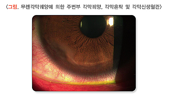 각막혼탁과 반흔, 원인, 증상, 치료법 정리 : 네이버 블로그