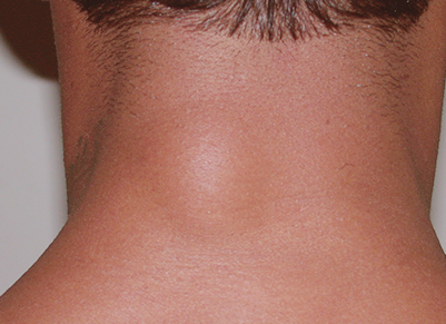  피부에 잘 생기는 양성종 2편 - 지방종(Lipoma)과 피부섬유종(Dermato-fibroma)