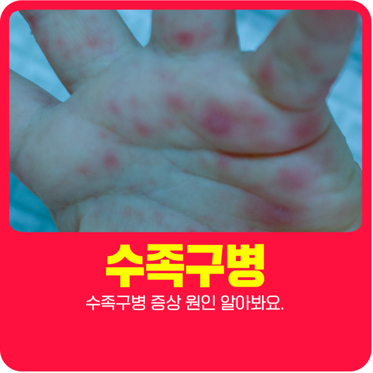  수족구병 증상 원인 알아봐요.