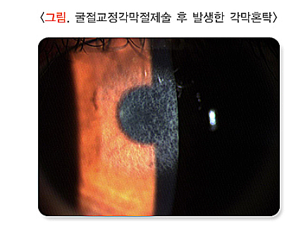 각막혼탁과 반흔, 원인, 증상, 치료법 정리 : 네이버 블로그