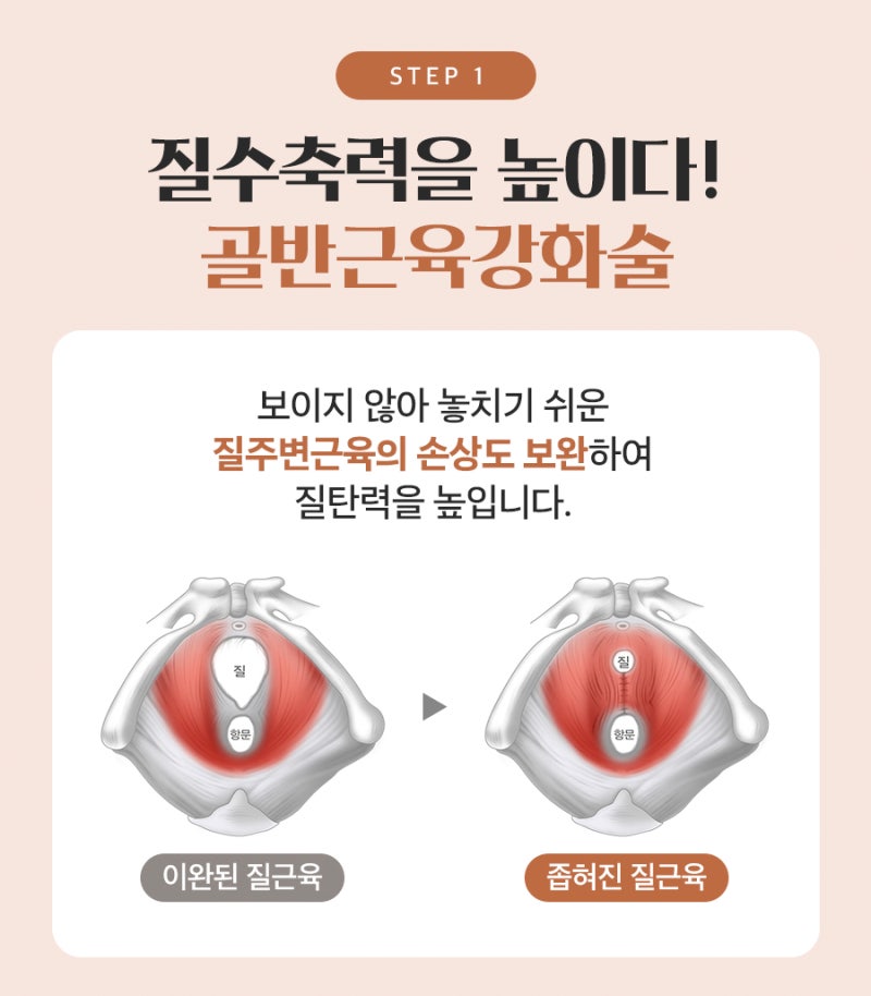 예쁜수술로 탄력을 효과적으로 개선하는 방법