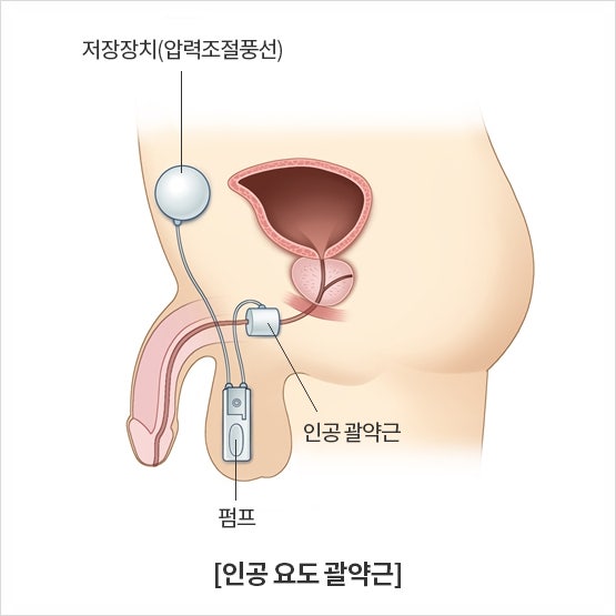 인공요도 괄약근 수술료와 재료 AMS Sphincter 급여기준, 금액 (남성 요실금 수술 비용)