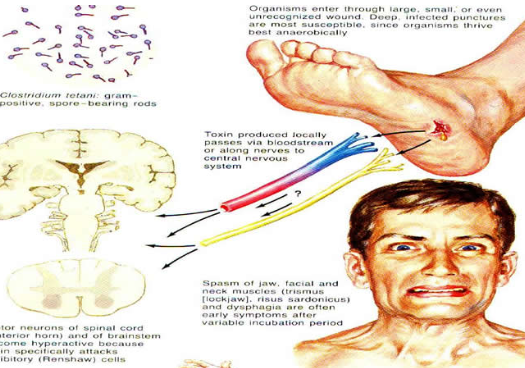 파상풍 초기 증상, 예방접종 주사 종류 (Dtap TD Tdap) : 네이버 블로그