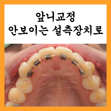  앞니교정 후기, 안보이는 설측장치로 해결가능할까?