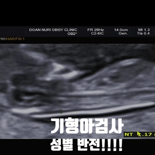 [다동이기록]<b>1차</b>/2차 기형아검사 결과, <b>아들</b>에서 딸로 성별... 