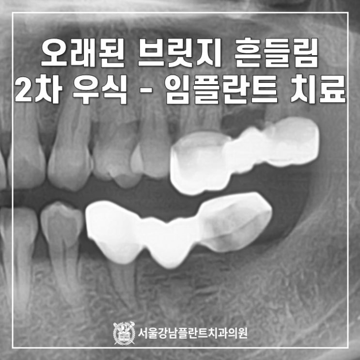  오래된 브릿지 흔들려요 - 브릿지 2차 우식 임플란트 치료