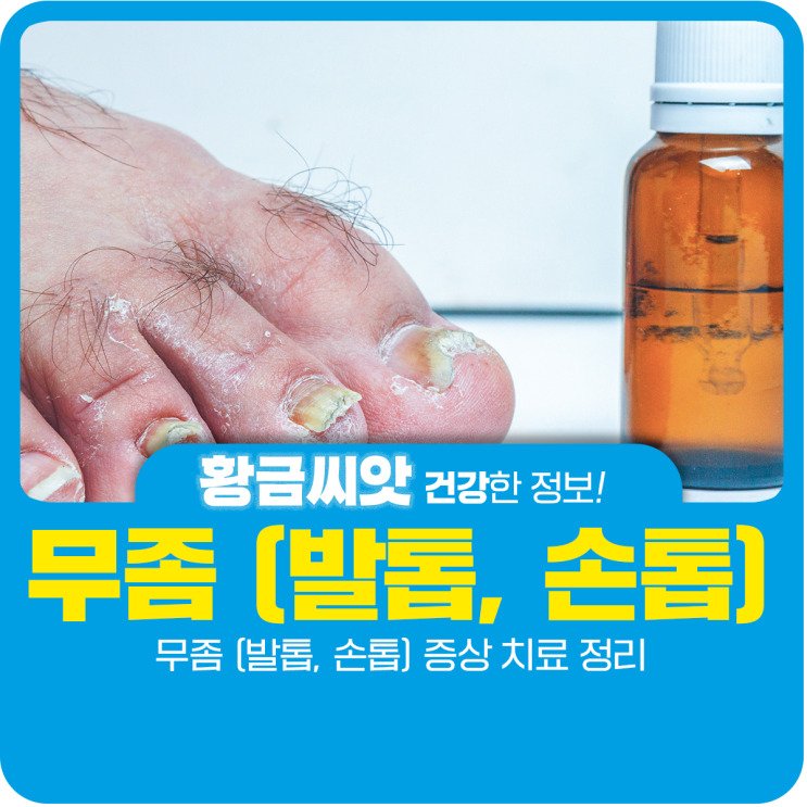  발톱 무좀 증상 치료 정리