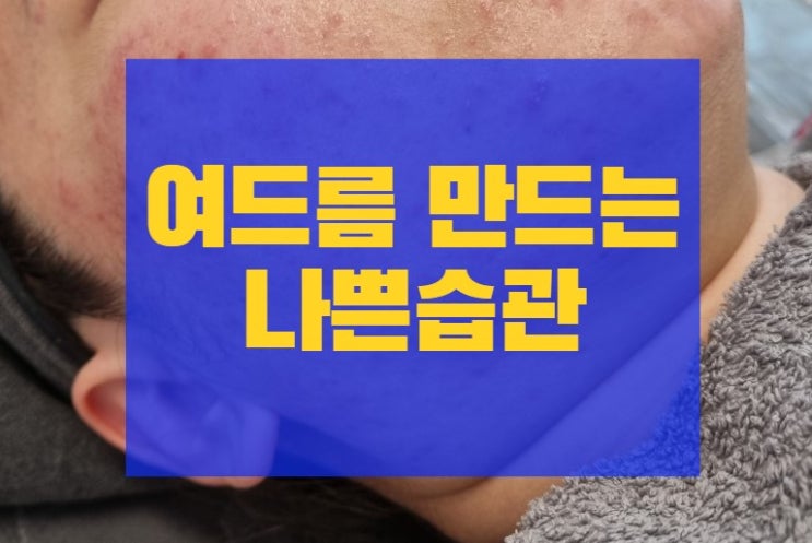  시흥 여드름, 피부에 안좋은 나쁜 습관 00만 고쳐보세요.
