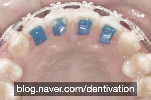 치아교정 바이트 터보 / 블루 레진 / 바이트 블록은 어떤 치료를 할 때 사용하는 걸까요? (Bite Turbo, Blue Resin Block)