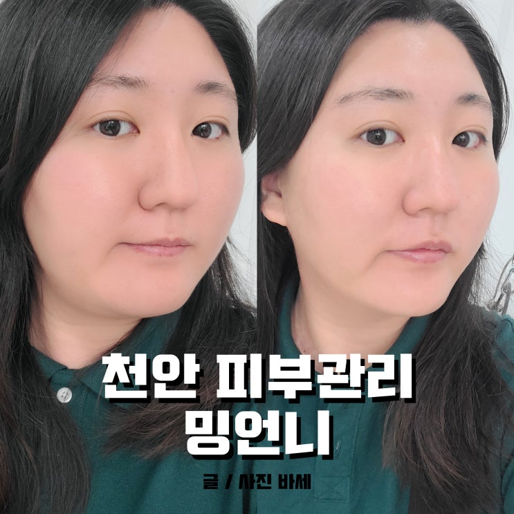  천안 피부관리, 셀럽피부관리 어디서? 밍언니 울써마지 케어로
