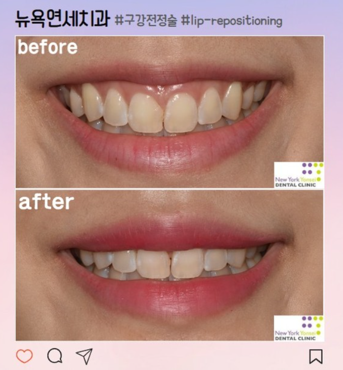  [강남역 거미스마일] 웃을 때 많이 보이는 잇몸이 고민이라면? 뉴욕연세치과만의 구강전정술로 해결! (feat.입술재배치술, lip repositioning)