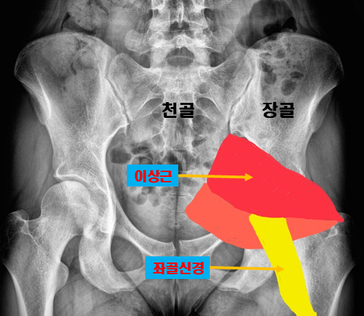 이상근증후군 병원, 엉치 골반 통증이 너무 아파요