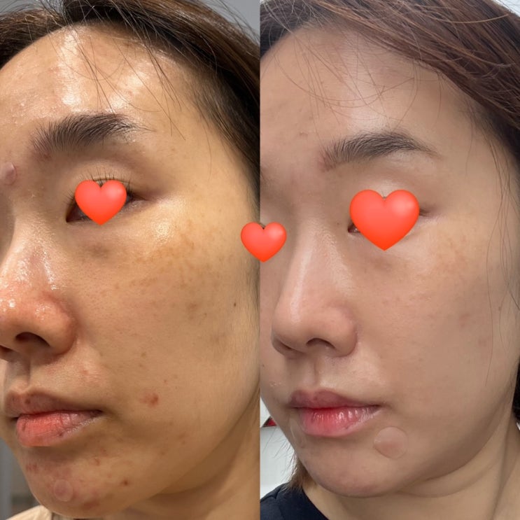  명동피부과 피코레이저 오타양모반 색소치료 2회차 후기, 가격