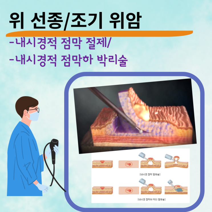  위암-내시경 시술