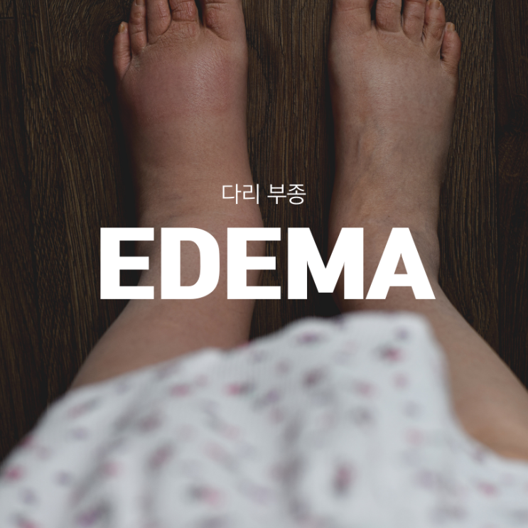  다리부종 발이 붓는 진짜 이유는 뭘까요?