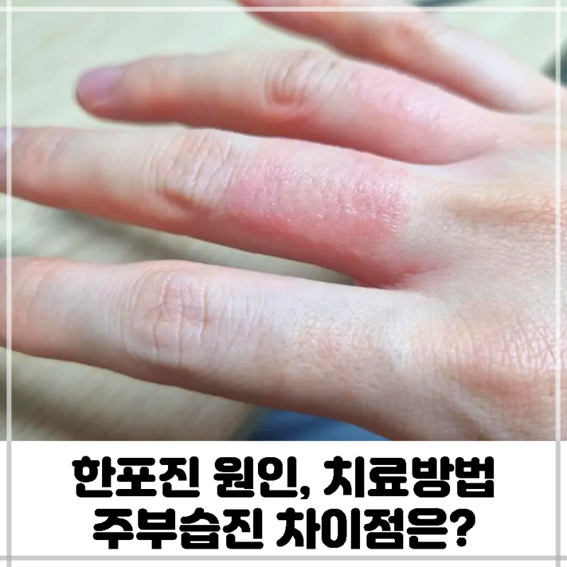 한포진 원인, 치료방법은? 주부습진 차이점 (임신중 손가락 발가락 수포, 가려움증) : 네이버 블로그