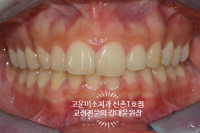 과개교합과 윗니돌출및 약간의 입술돌출 비대칭을 주소로 내원한 2급 부정교합치료증례 신촌교정치과 고운미소 신촌1호점 치료증례