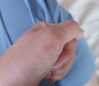 지네 물렸을 때 지네 물림 알레르기 반응 후기(사진주의)+퇴치법