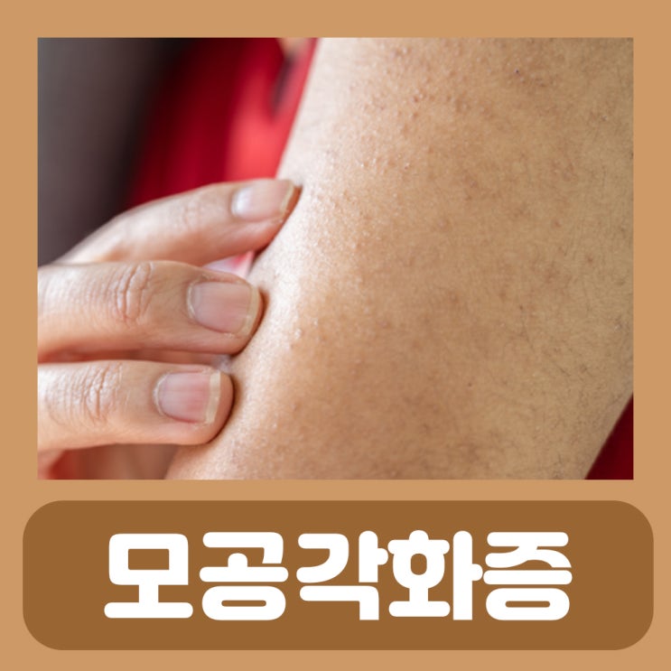 모공각화증 레이저 연고 치료 비용 팔뚝 다리 모공각화증