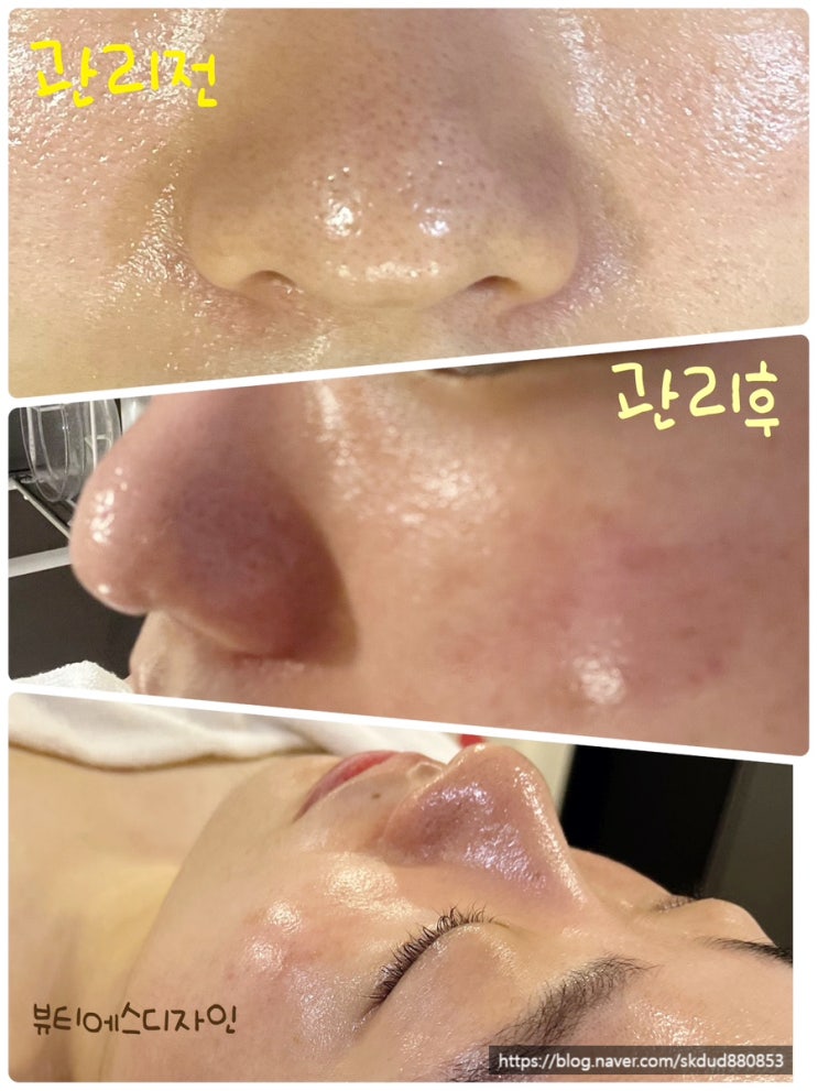  원주피부관리(윤곽순환관리, 모공디톡스)받으러 다시 방문한 원주 관설동 "뷰티에스디자인"
