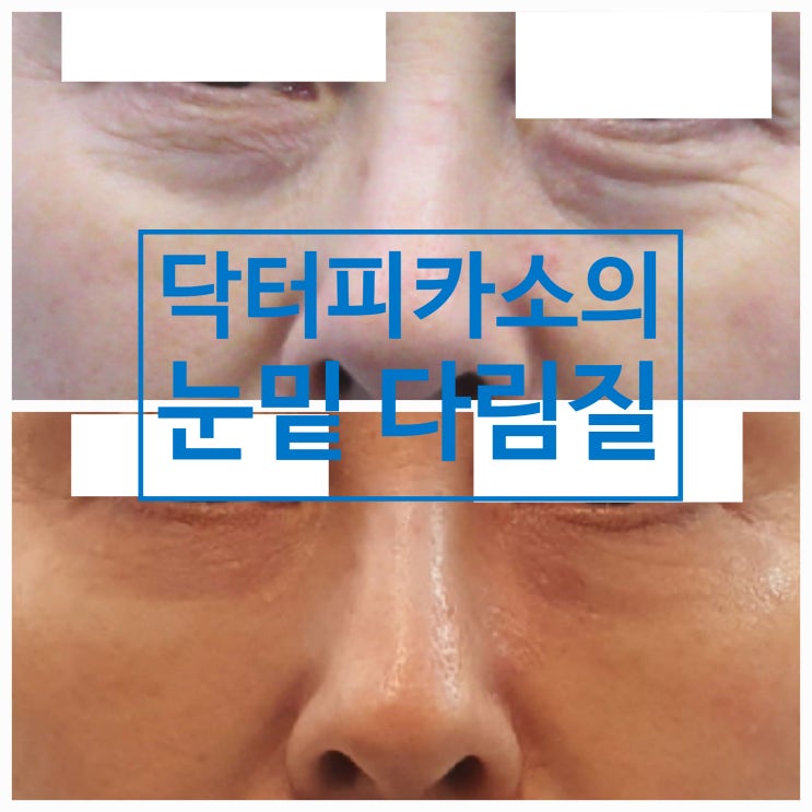  #46.눈밑뽀개기III.닥터피카소의 눈밑다림질시술(feat.눈밑 지방 꺼짐 주름)