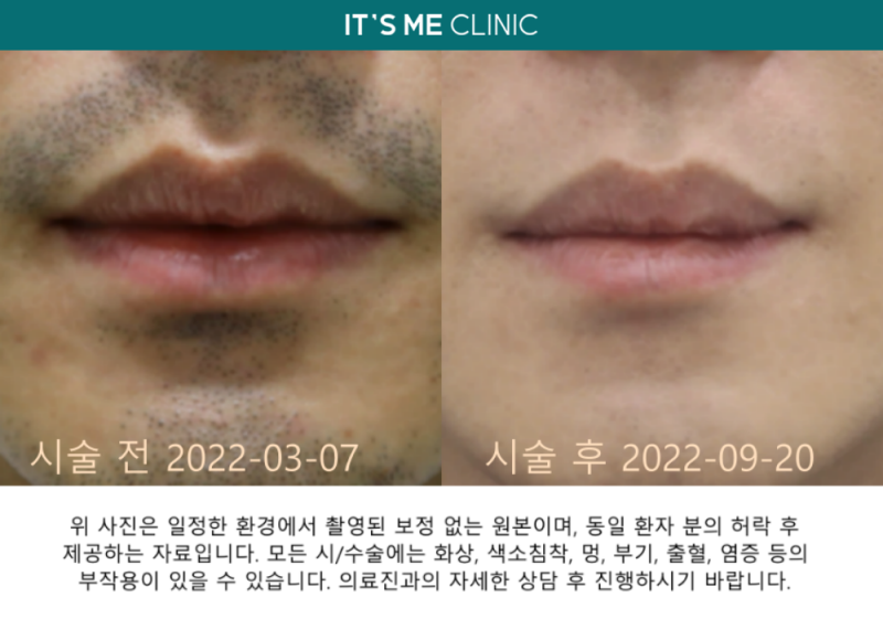 대전 레이저 제모? 의사가 답한 3가지 질문 2