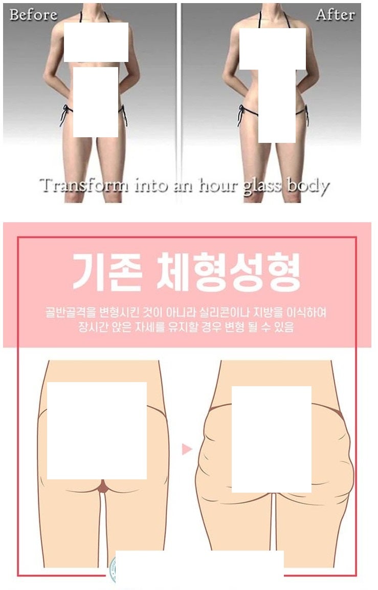  골좁이 천지인 한녀들에게서 필수인 성형 수술 골반 성형