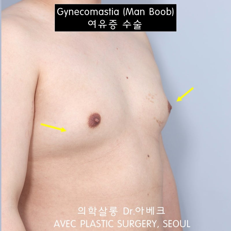 가슴 확대 수술 후 무엇을 고려해야 하나요?