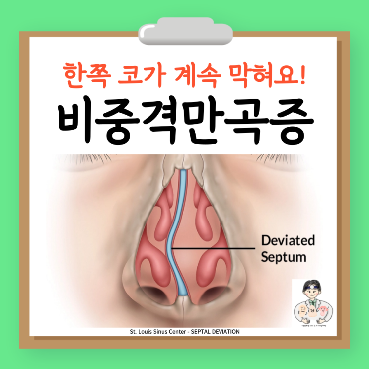  비중격만곡증 코막힘 원인 증상 진단 치료 수술