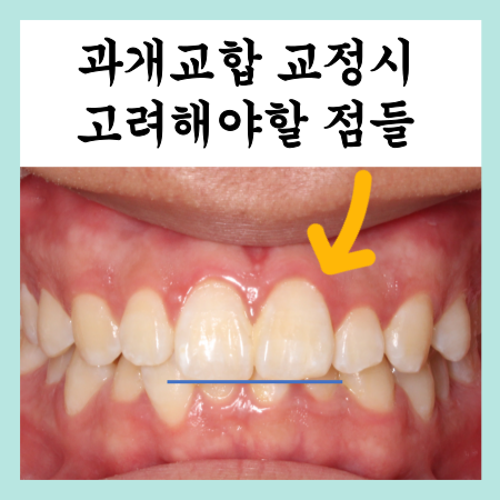  과개교합 교정, 이가 깊게 물려요 기간 및 전후사진