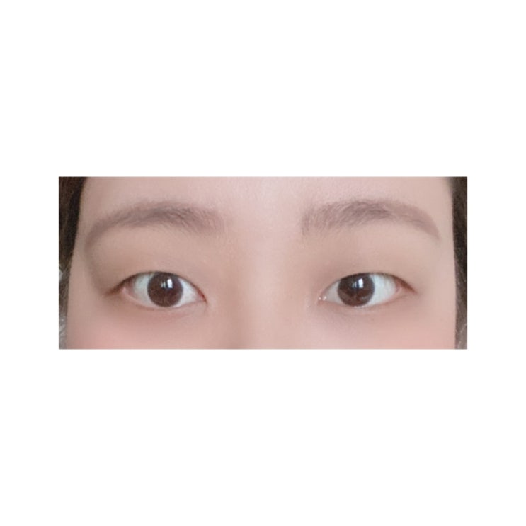  쌍수 후기 2 (절개, 눈매교정,인아웃라인,세미아웃라인) 쌍수당일~ 일주일