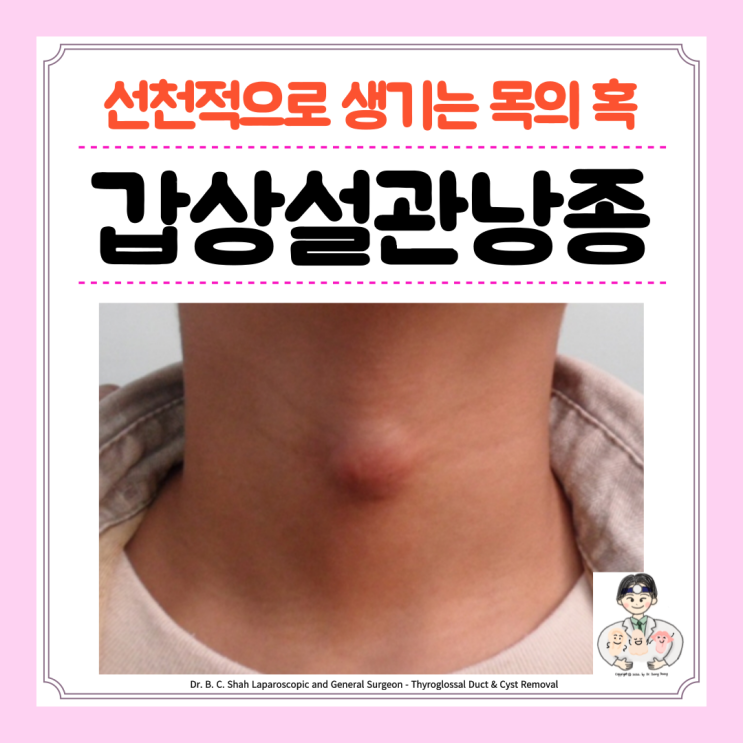  갑상설관낭종 원인 증상 검사 Sistrunk 수술 예후