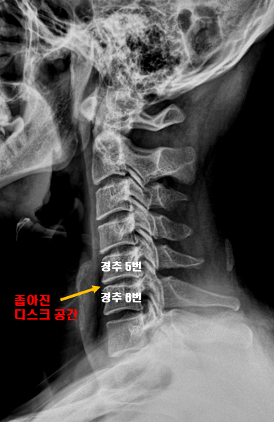  경추추간판탈출증? 팔 저림과 목 통증 궁금증 해결해 드립니다