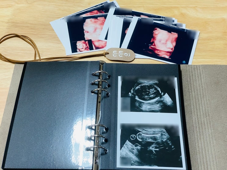  [26주 차] 입체 초음파 검사(이것도 세 번이나ㄷㄷㄷ) & 임신성 당뇨 검사