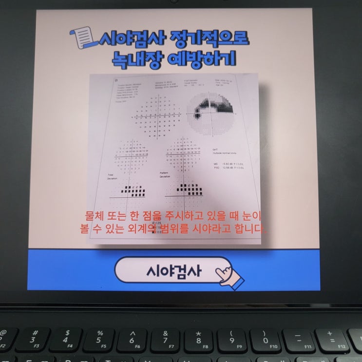  시야검사 정기적으로 녹내장 예방하기